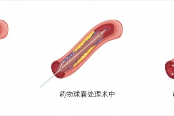 微创植介入成血管疾病医治干流手法「申淇医疗」自主研制药物涂层球囊